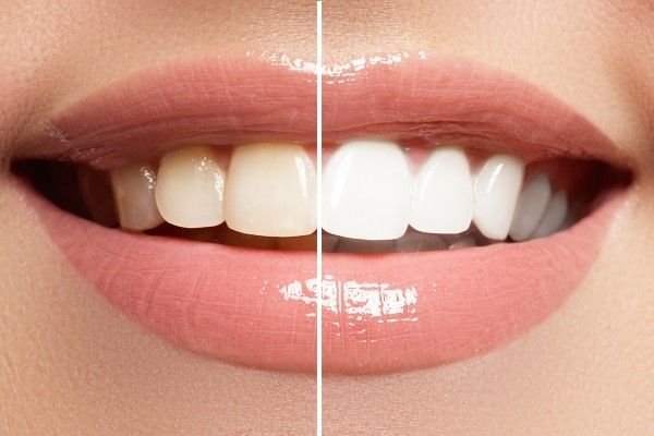 قبل و بعد از خمیر دندان سفید کننده مدیبلانک MEDIBLANC حجم 100میلی لیتر