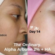 تغییرات شگفت انگیز چهارده روزه استفاده از سرم آلفا آربوتین ۲% + هیالورونیک اسید اوردینری Ordinary