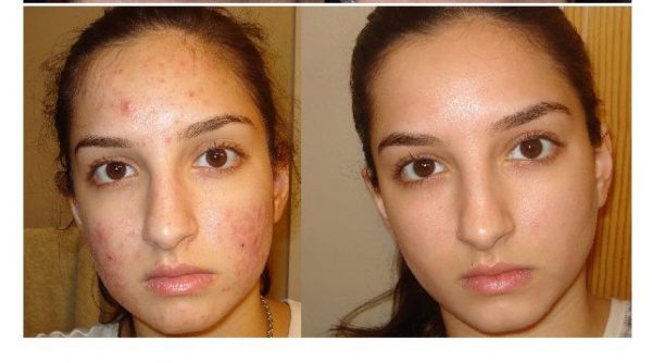 قبل و بعد از سرم سالسیلیک اسید %2 رولوشن Revolution