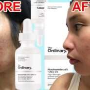 قبل و بعد از استفاده از سرم نیاسینامید اوردینری در طول یک ماه