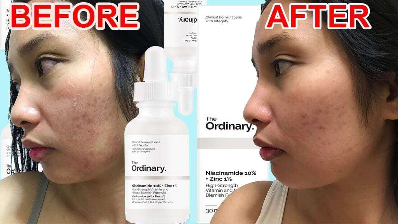 قبل و بعد از استفاده از سرم نیاسینامید اوردینری در طول یک ماه