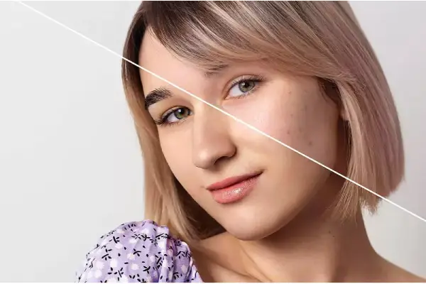 Glycolic Acid برای چه نوع پوستی مناسب است