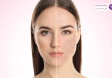 قبل و بعد از درمان منافذ باز پوستی با روتین مراقبتی